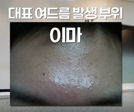 [인천점] 인천피부한의원 좁쌀여드름 방치하면 안되는 이유는? - 해율한의원