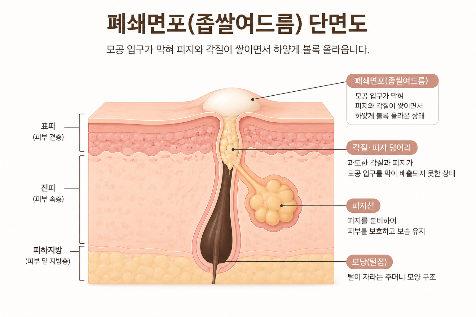 좁쌀여드름(폐쇄 면포)가 생기는 원인을 보여주는 그림
