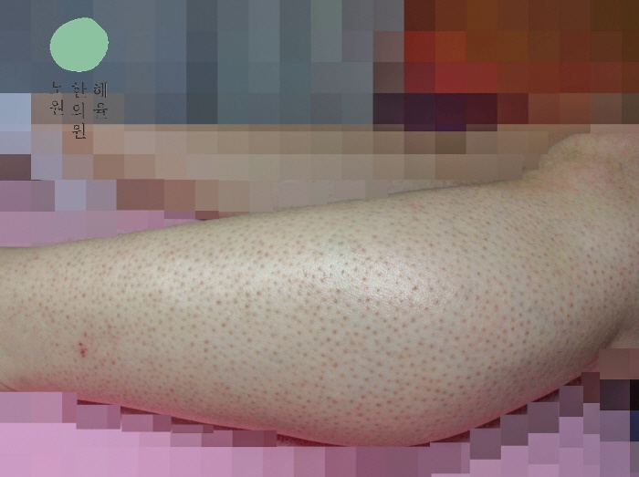 [노원점] 종아리모공각화증 눈에 띄는 붉은 자국 신경 쓰인다면 노원 해율한의원 관리 과정은? - 해율한의원