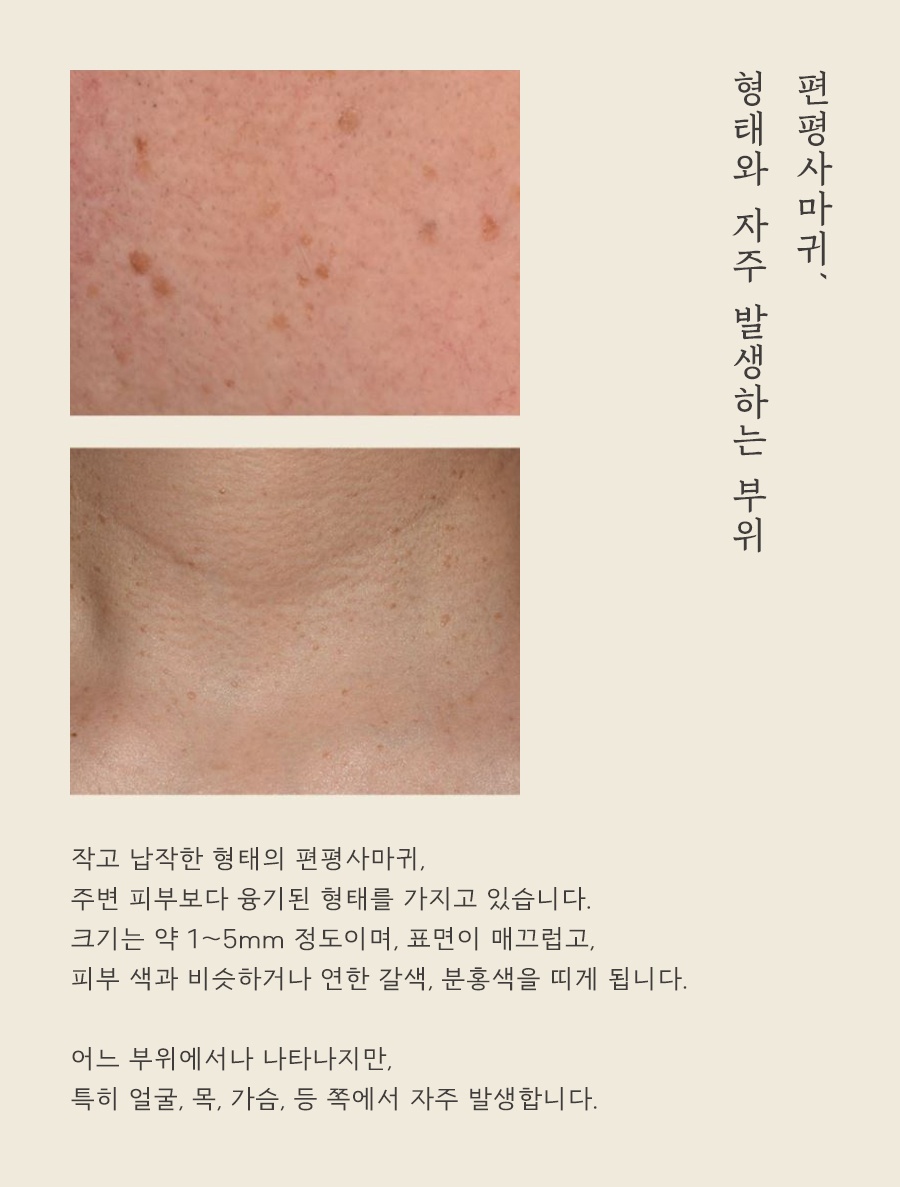[창원점] 창원편평사마귀 제거 후 딱지와 붉은기는 어떻게 관리할까? - 해율한의원