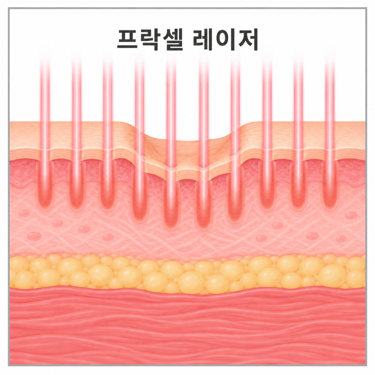 프락셀 레이저의 작용방식을 보여주는 사진