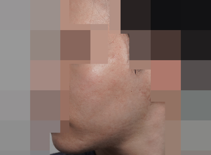 [안양점] 안양여드름치료 기간은 얼마나 걸릴까요? - 해율한의원