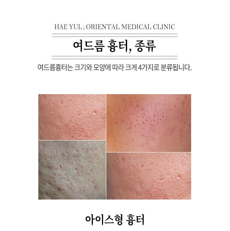 [안산점] 안산새살침 시술의 원리와 특징 알아봐요 - 해율한의원