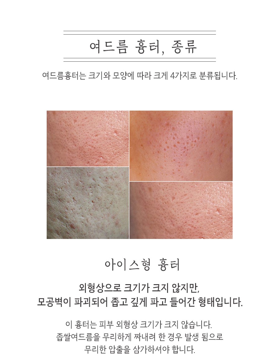 [광주점] 여드름흉터 시간 지나면 자연스럽게 없어질까요? 광주해율한의원에서 알려드립니다 - 해율한의원