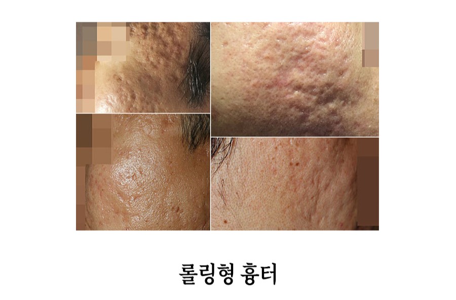 [안산점] 안산새살침 시술의 원리와 특징 알아봐요 - 해율한의원