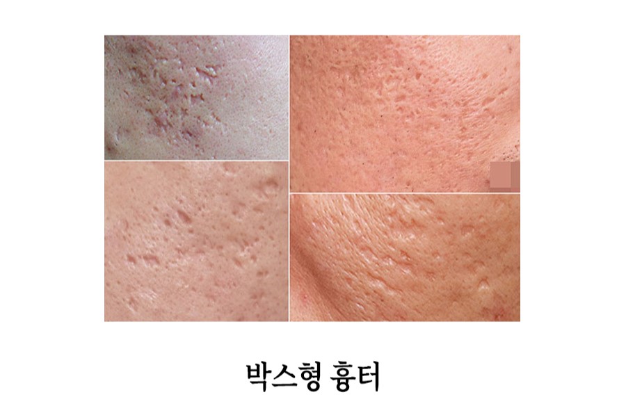 [안산점] 안산새살침 시술의 원리와 특징 알아봐요 - 해율한의원