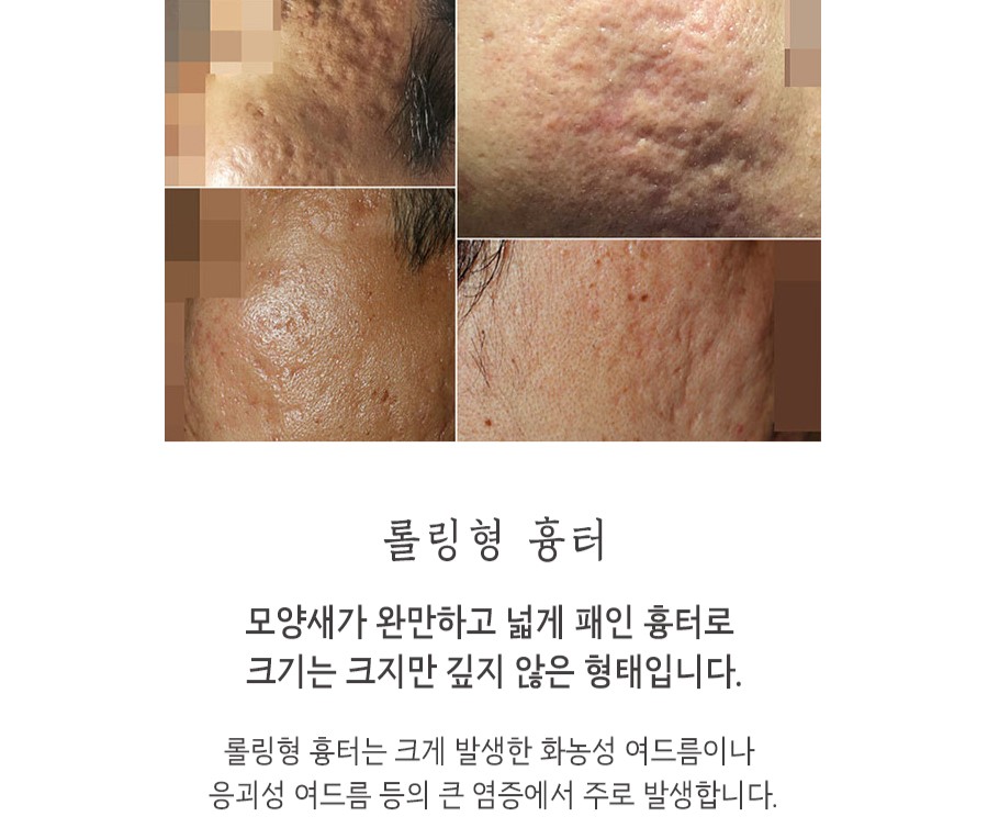[광주점] 여드름흉터 시간 지나면 자연스럽게 없어질까요? 광주해율한의원에서 알려드립니다 - 해율한의원