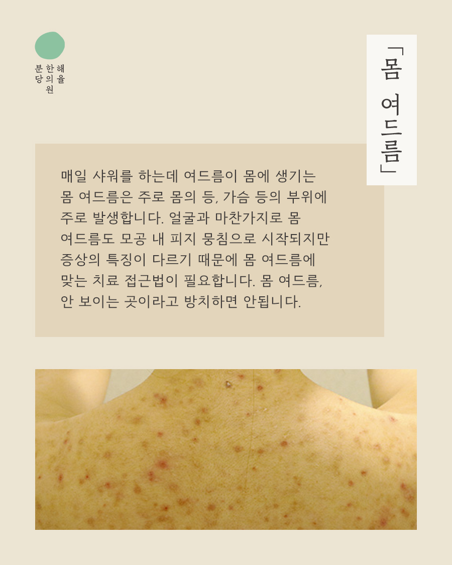 [분당점] 가슴여드름관리 미세약초침은 자국에 어떻게 활용하나요? 분당 해율한의원에서 설명드립니다 - 해율한의원