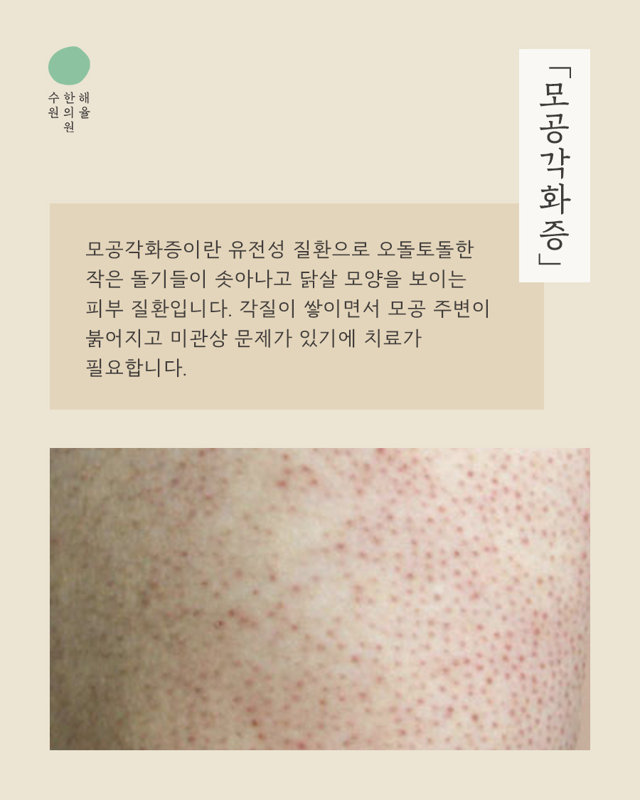 [수원점] 모공각화증 과연 일시적인 현상일까요?수원해율한의원 치료 방법 - 해율한의원