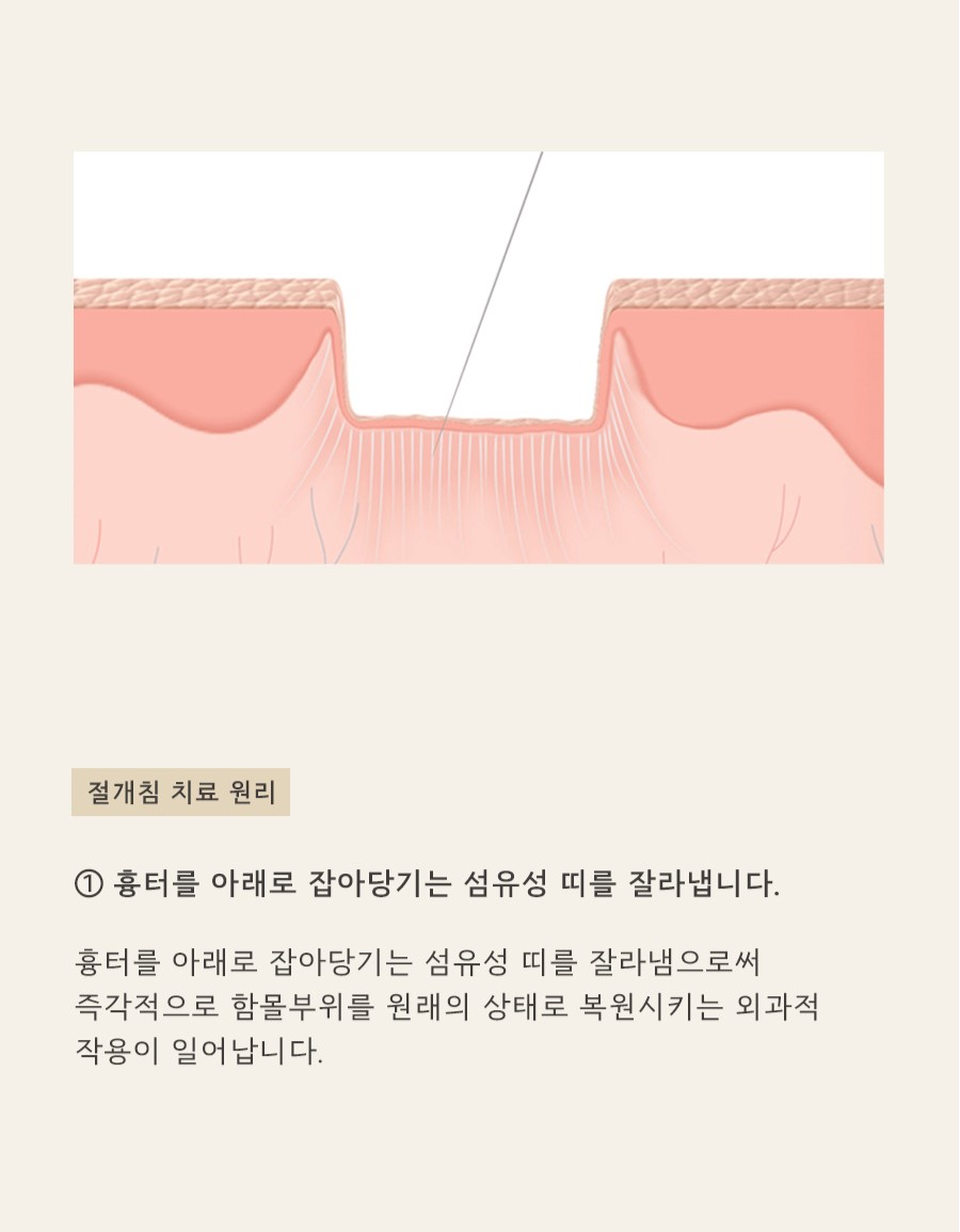 [천안점] 천안여드름흉터 vs 자국 차이점과 치료방법은? - 해율한의원