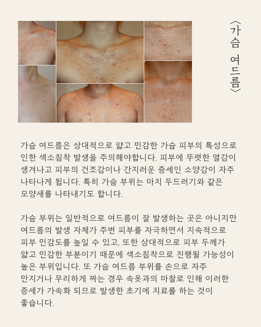 [천안점] 가슴여드름 가드름 색소 침착, 자국 남는 이유는? 천안 해율한의원에서 설명드립니다 - 해율한의원