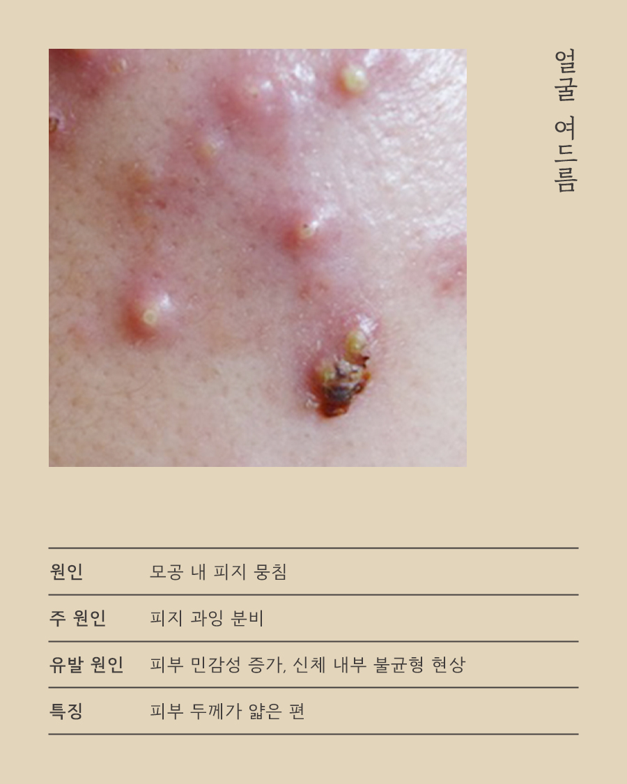 [분당점] 분당등여드름 등드름 유독 자국이 심하게 남는 이유는? - 해율한의원