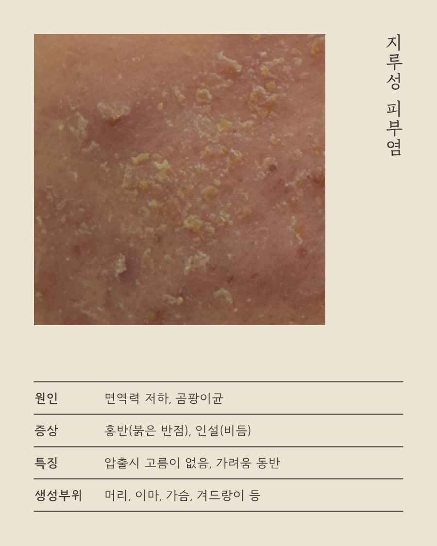 [수원점] 수원지루피부염 화장이나 선크림을 사용해도 되나요? - 해율한의원