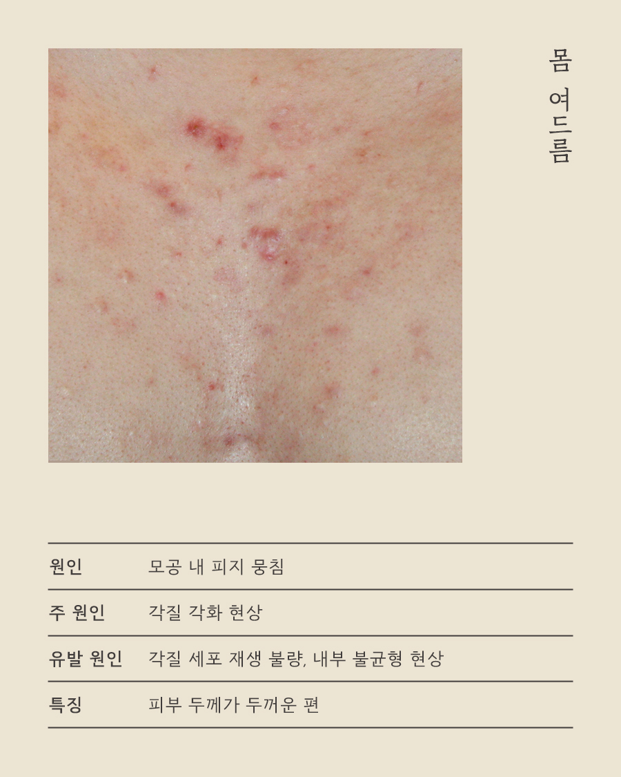 [분당점] 분당등여드름 등드름 유독 자국이 심하게 남는 이유는? - 해율한의원