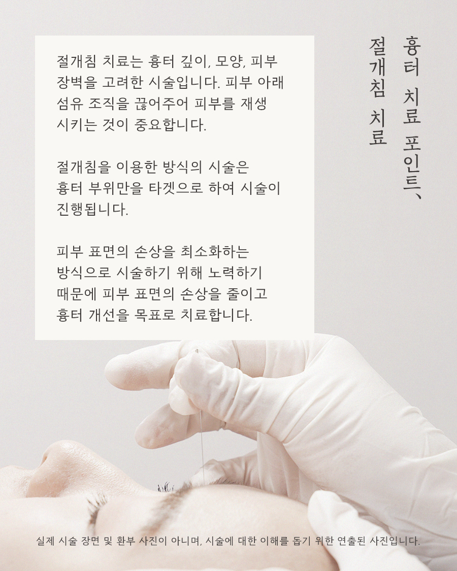 [천안점] 천안여드름흉터 vs 자국 차이점과 치료방법은? - 해율한의원