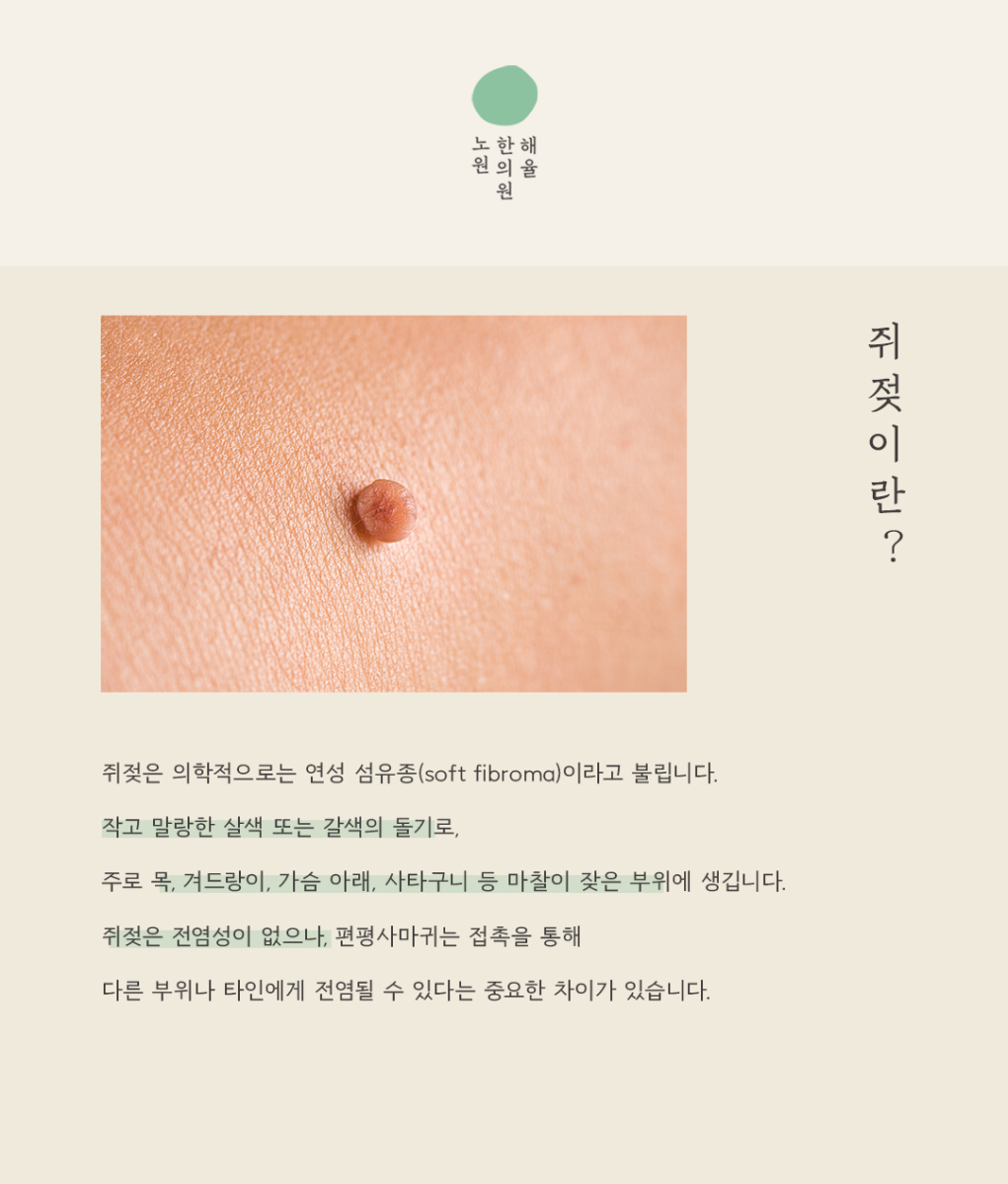 [노원점] 노원쥐젖 집에서 직접 제거해도 괜찮을까요? - 해율한의원