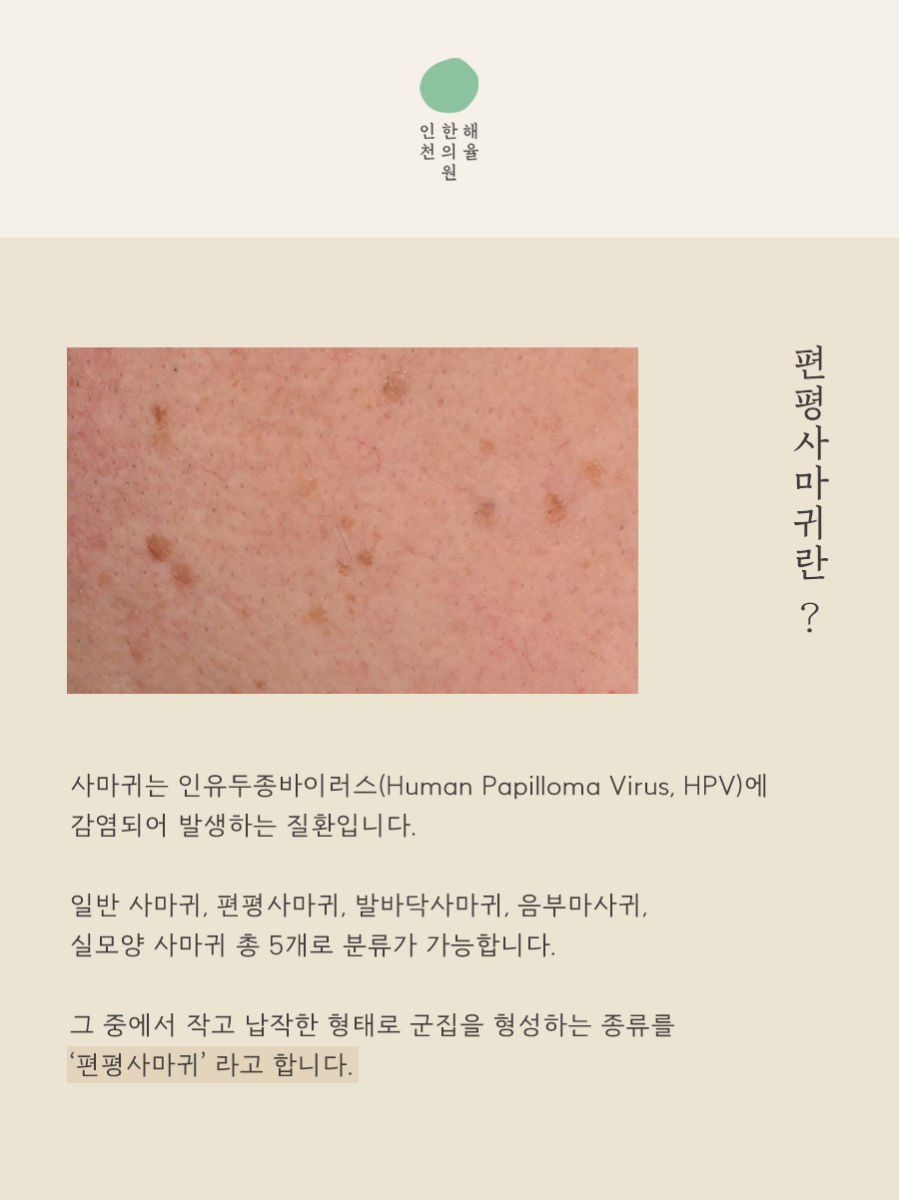 [인천점] 인천편평사마귀 제거 언제 치료하는게 좋을까요? - 해율한의원