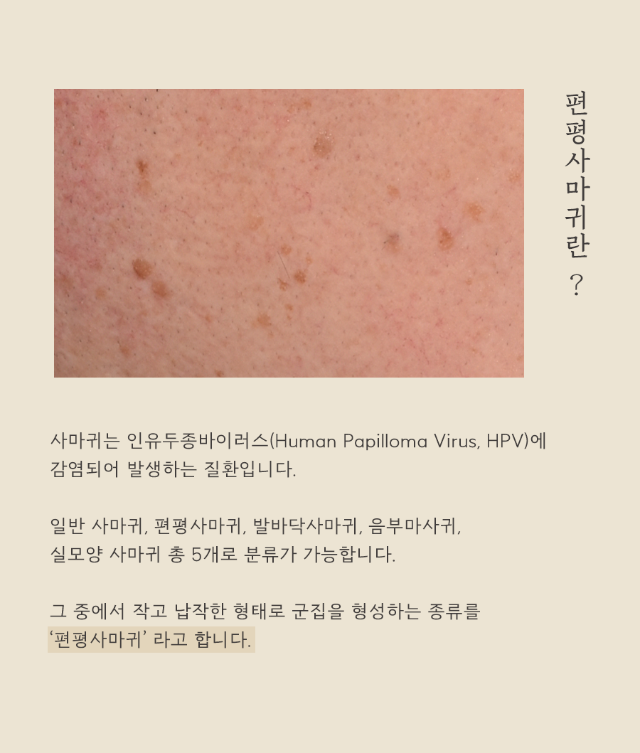 [인천점] 편평사마귀, 왜 생기고 어떻게 치료해야 할까요? - 해율한의원