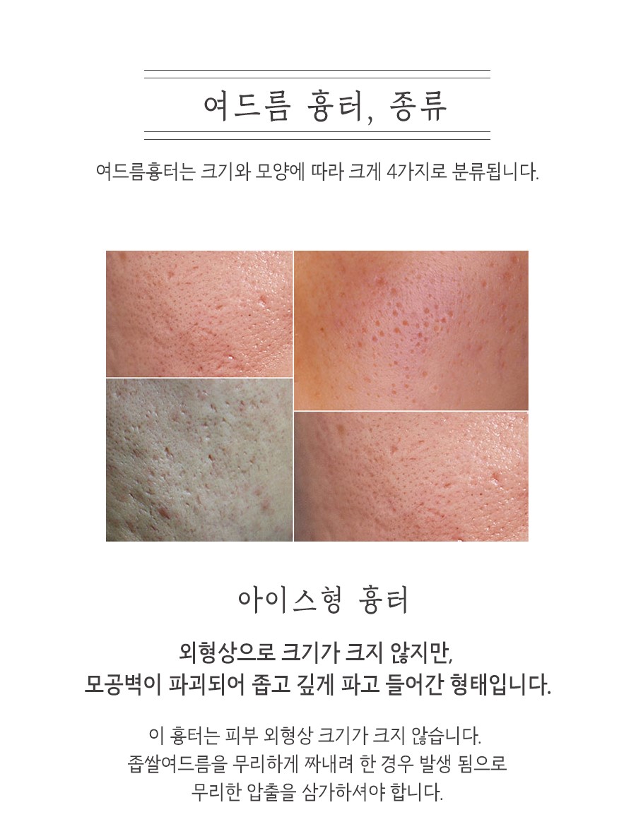 [창원점] 창원여드름흉터 오래된 것도 치료할 수 있을까요? - 해율한의원