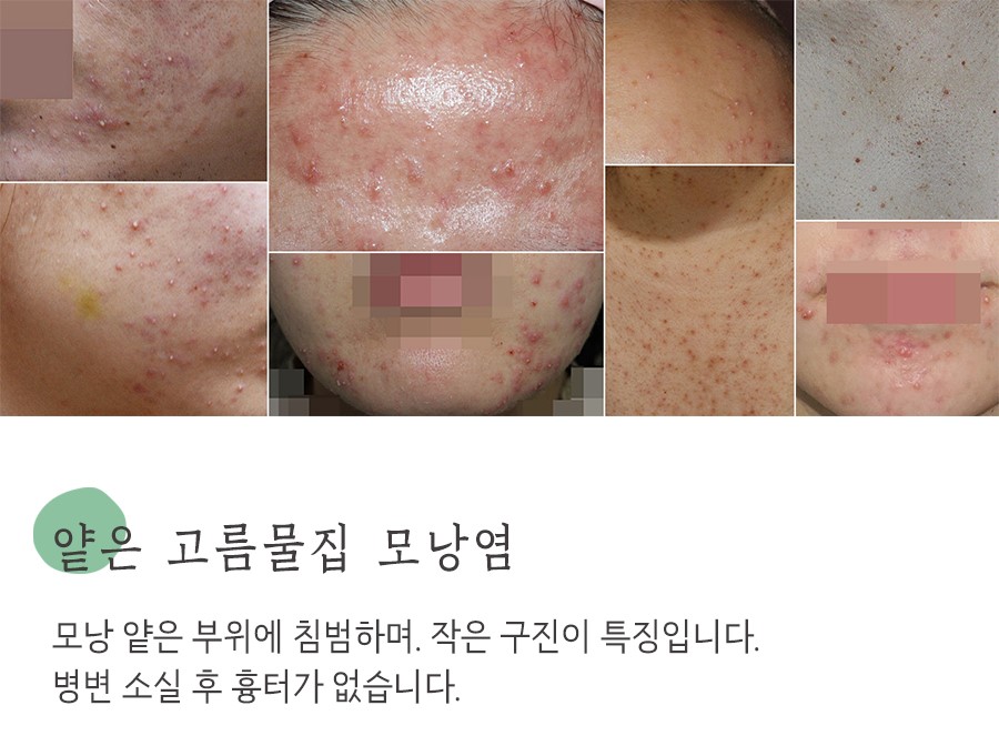 [분당점] 분당모낭염 압출하면 안되는 이유, 원장님이 설명드립니다 - 해율한의원