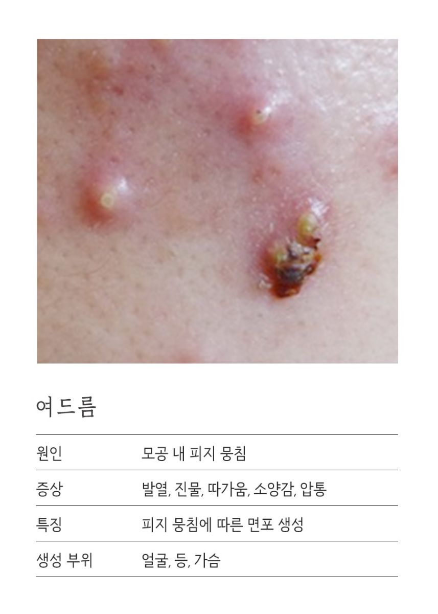 [대구점] 대구지루피부염, 주사피부염과 어떻게 다른가요? - 해율한의원