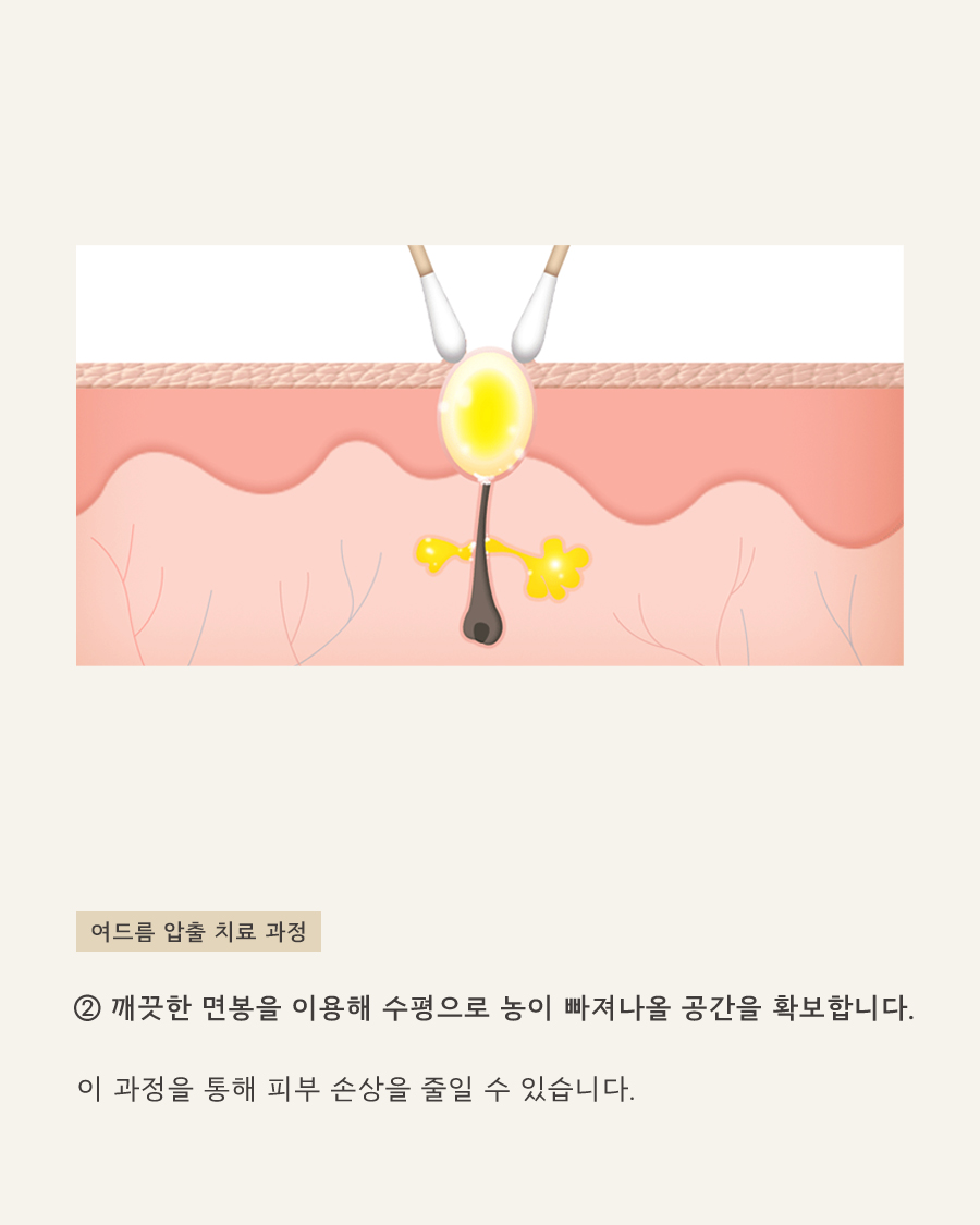 [목동점] 여드름, 어떻게 관리해야 할까요? - 해율한의원