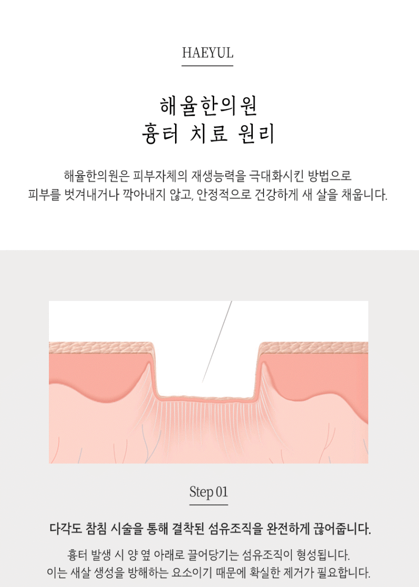 [창원점] 창원여드름흉터 오래된 것도 치료할 수 있을까요? - 해율한의원