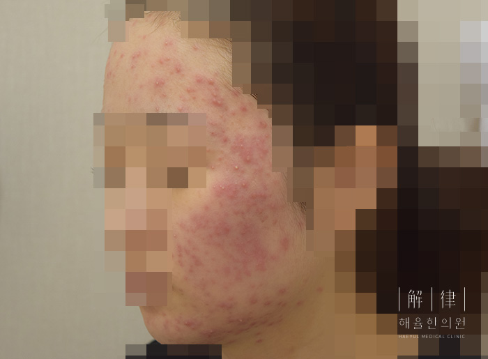 [안산점] 안산여드름치료 딱딱하게 만져지는 여드름도 압출할 수 있나요? - 해율한의원