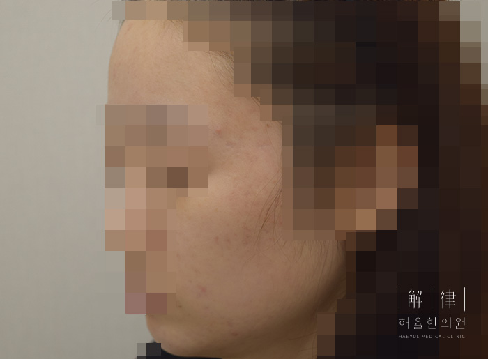 [안산점] 안산여드름치료 딱딱하게 만져지는 여드름도 압출할 수 있나요? - 해율한의원