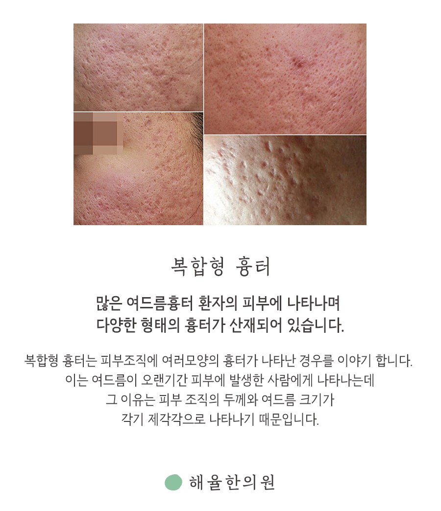 [인천점] 인천새살침 흉터 모양에 따라 치료방법도 달라지나요? - 해율한의원