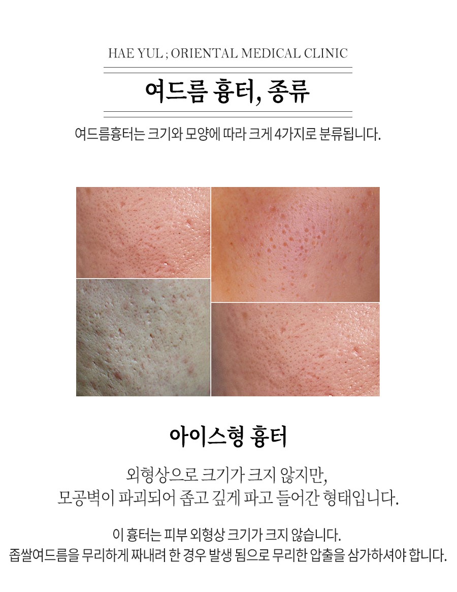 [홍대점] 홍대여드름흉터 오래된 경우에도 치료  가능한가요? - 해율한의원