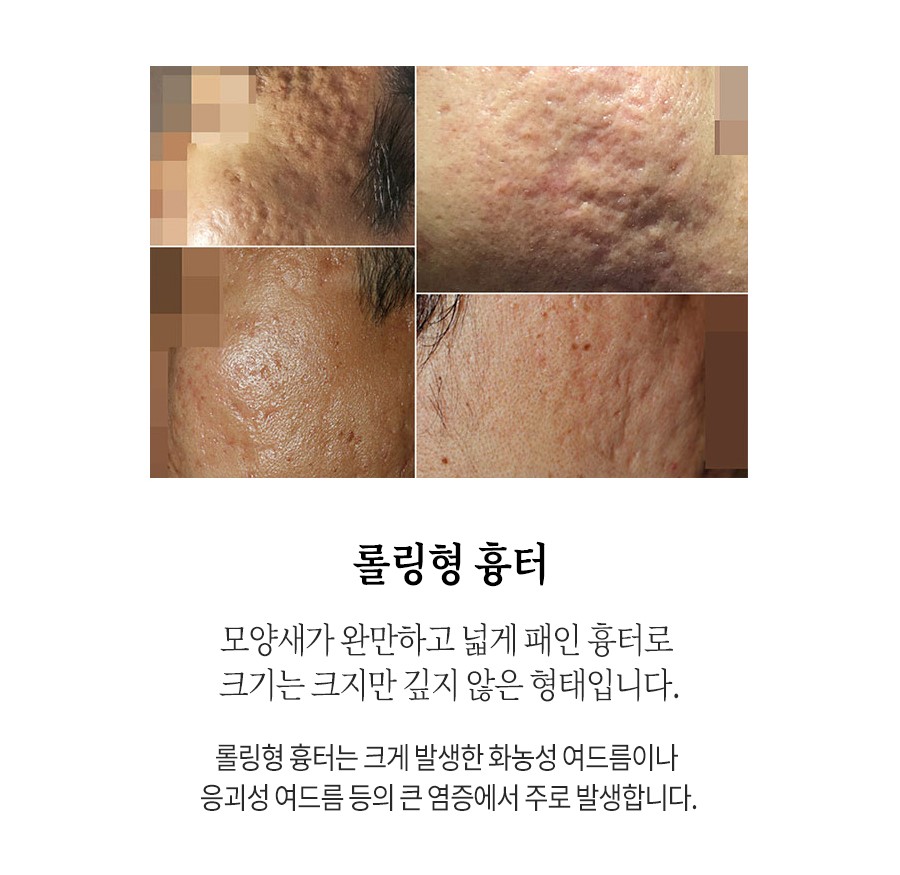 [홍대점] 홍대여드름흉터 오래된 경우에도 치료  가능한가요? - 해율한의원