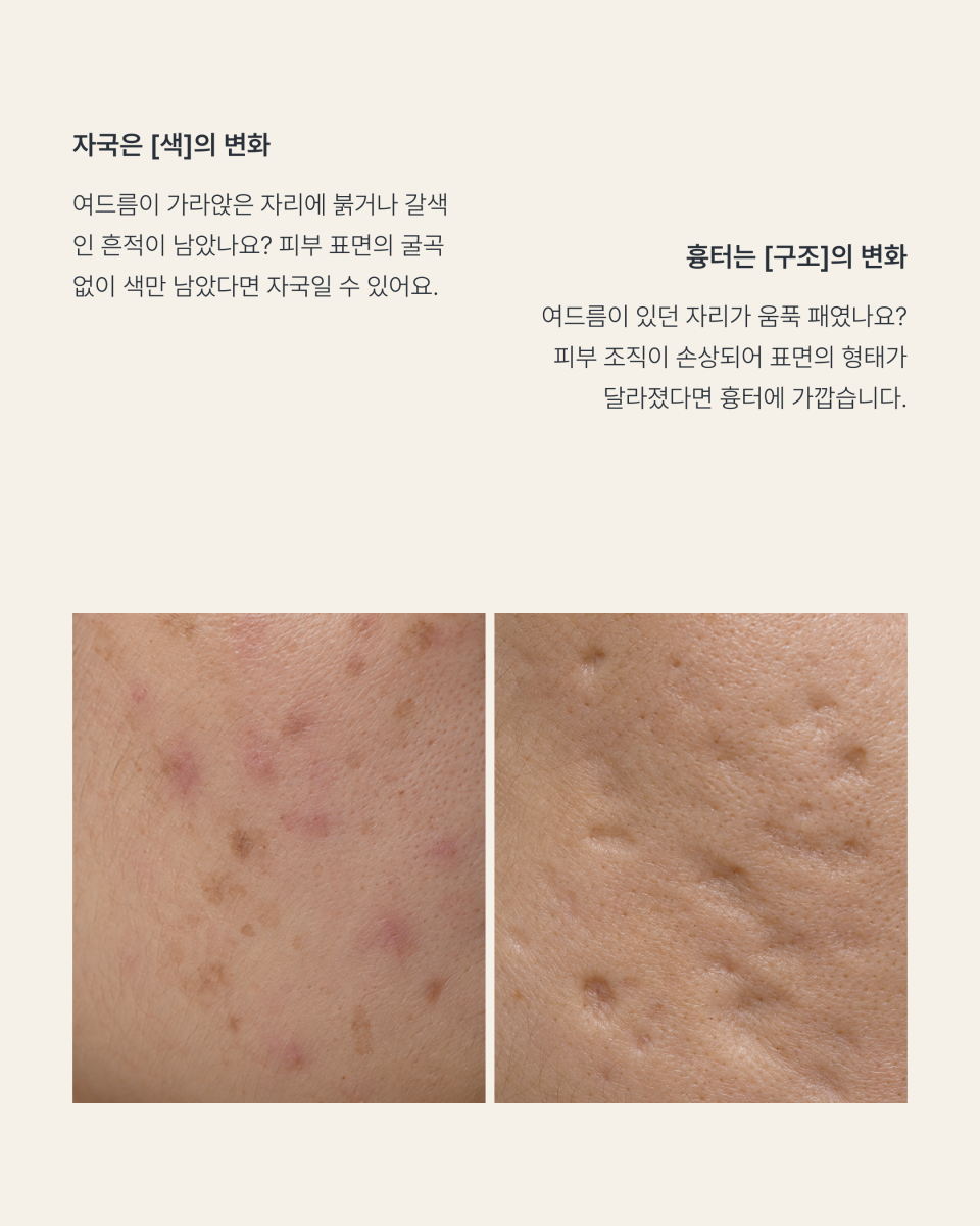 [수원점] 여드름 자국과 흉터 어떻게 구분할까요? - 해율한의원