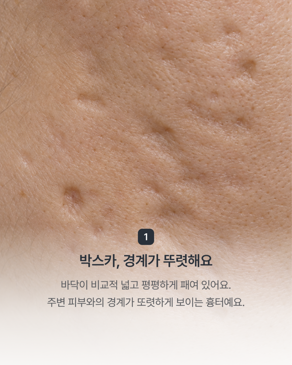 [강남점] 패인 여드름 흉터, 모양에 따라 치료 방향이 달라져요 - 해율한의원