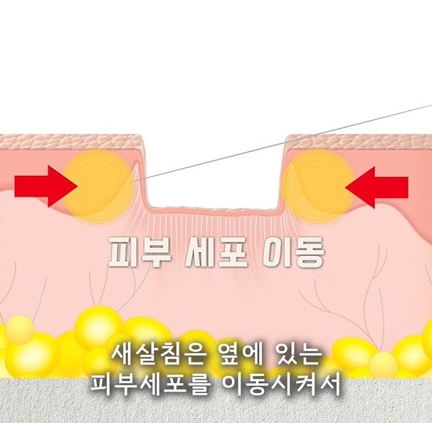 [대구점] 대구여드름흉터 새살침과 서브시전 치료 방법 - 해율한의원
