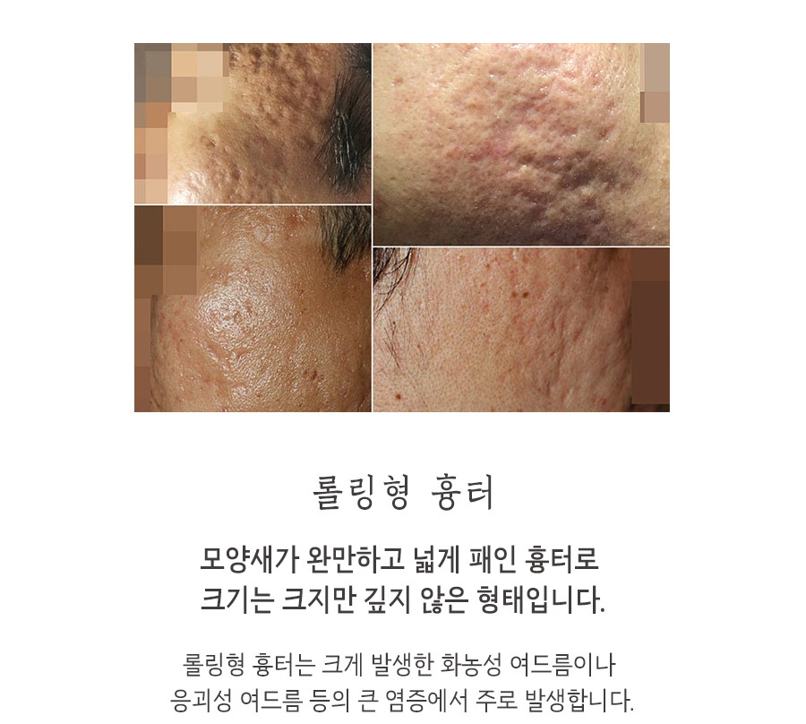 [창원점] 창원여드름흉터 오래된 것도 치료할 수 있을까요? - 해율한의원