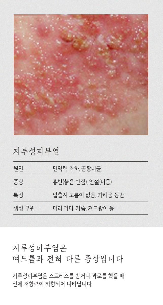 [대구점] 대구지루피부염, 주사피부염과 어떻게 다른가요? - 해율한의원