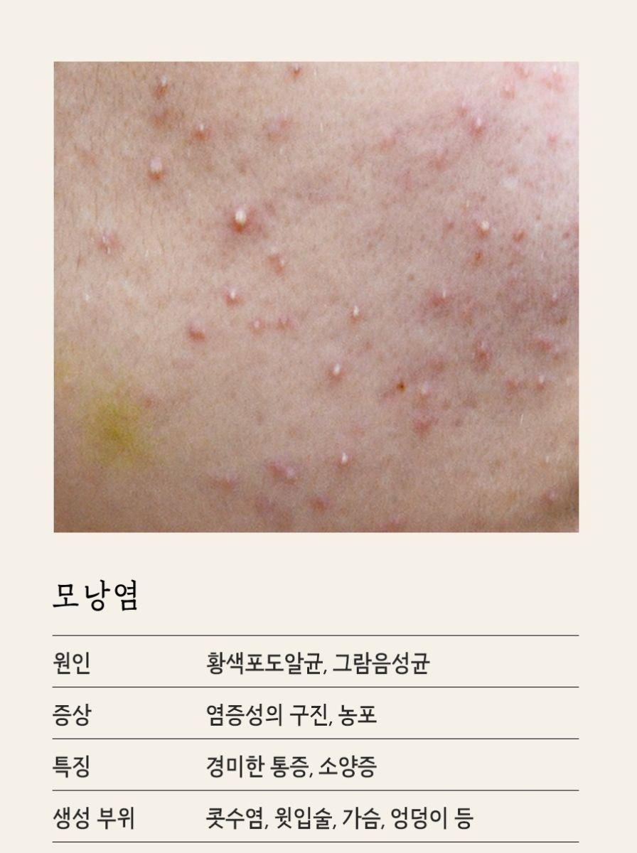 [분당점] 분당모낭염 압출하면 안되는 이유, 원장님이 설명드립니다 - 해율한의원