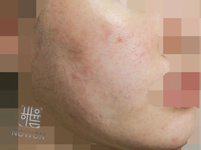 [분당점] 지루성피부염 붉고 가려운 이유, 치료까지 분당 해율한의원이 설명드립니다 - 해율한의원