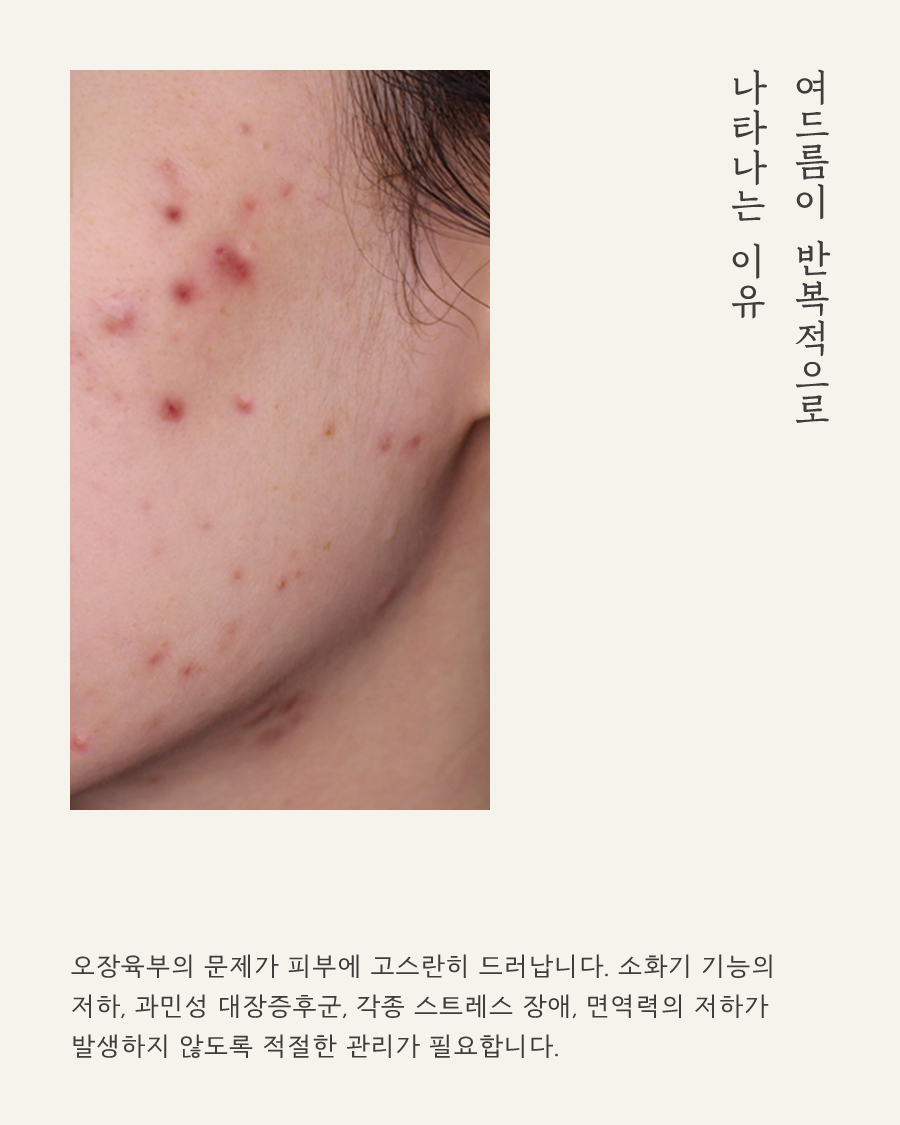 [대구점] 피부한의원 치료와 일상 속 여드름 관리법 대구해율한의원 꿀팁 - 해율한의원
