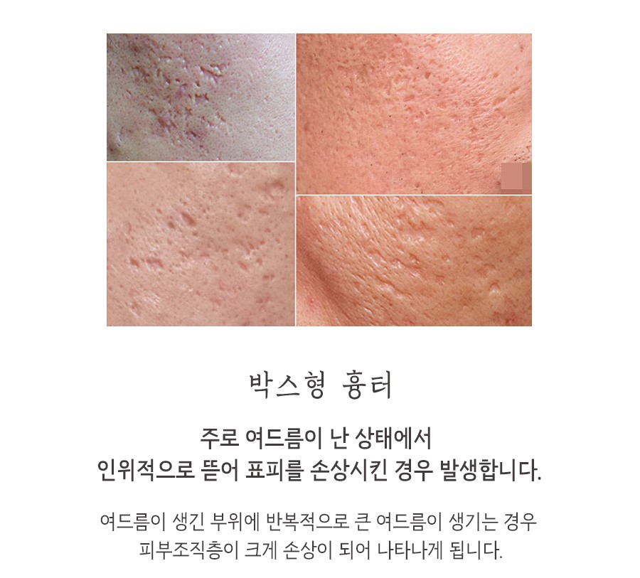 [창원점] 창원여드름흉터 오래된 것도 치료할 수 있을까요? - 해율한의원