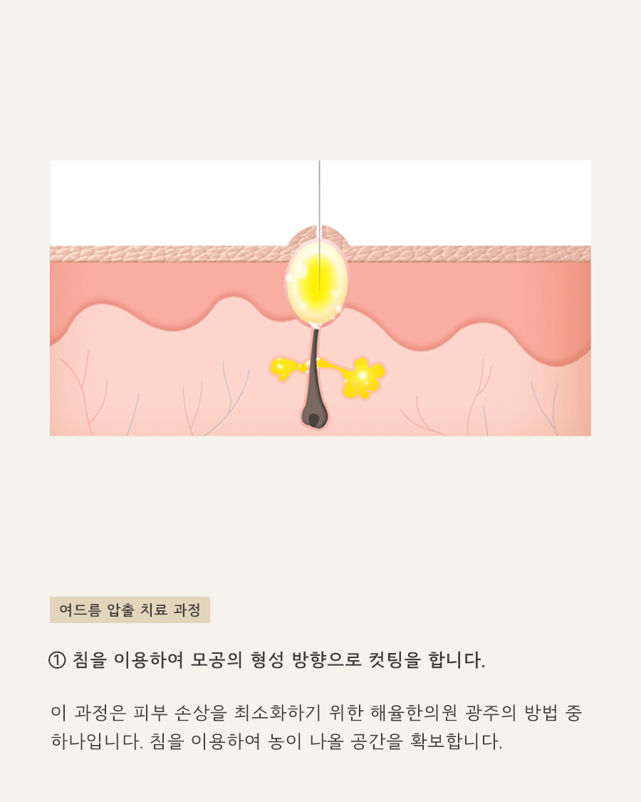 [노원점] 노원여드름치료 여드름과 흉터를 동시에 치료 할 수 있나요? - 해율한의원