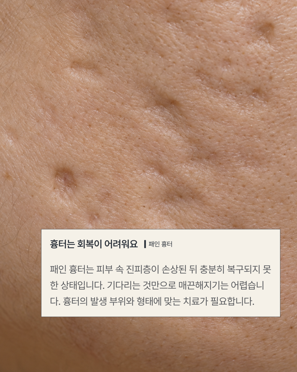[수원점] 여드름 자국과 흉터 어떻게 구분할까요? - 해율한의원
