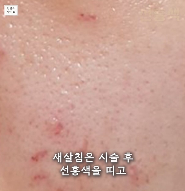 [대구점] 대구여드름흉터 새살침과 서브시전 치료 방법 - 해율한의원
