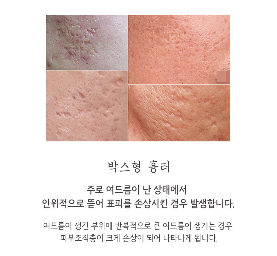[안산점] 안산여드름흉터 오래된 흉터도 치료할 수 있나요? - 해율한의원
