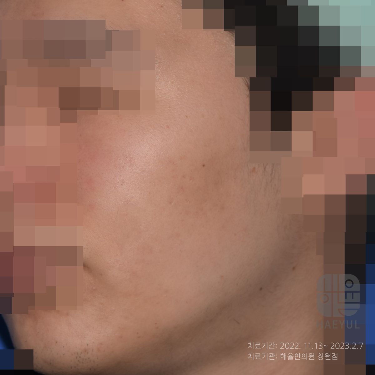 [창원점] 여드름자국 미세약초침 시술 필요한 이유 창원해율한의원과 알아봐요 - 해율한의원