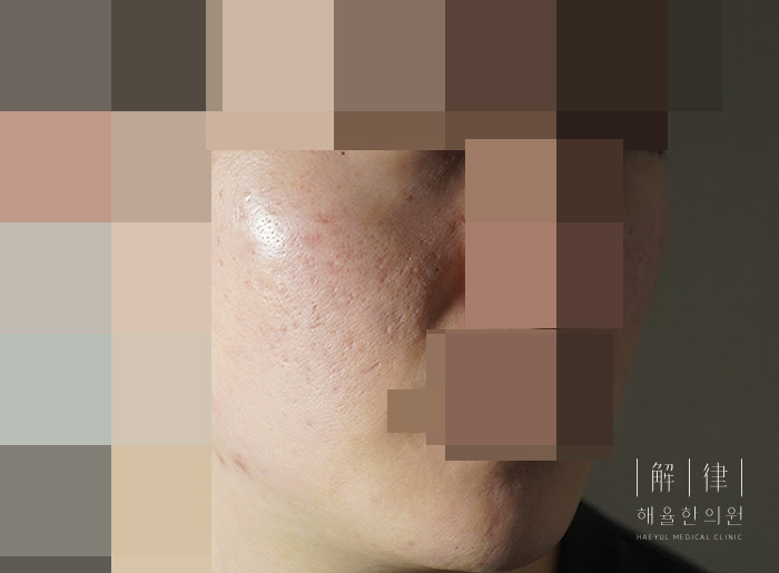 [안산점] 안산새살침 시술의 원리와 특징 알아봐요 - 해율한의원