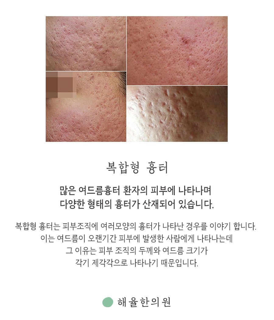 [안산점] 안산여드름흉터 오래된 흉터도 치료할 수 있나요? - 해율한의원