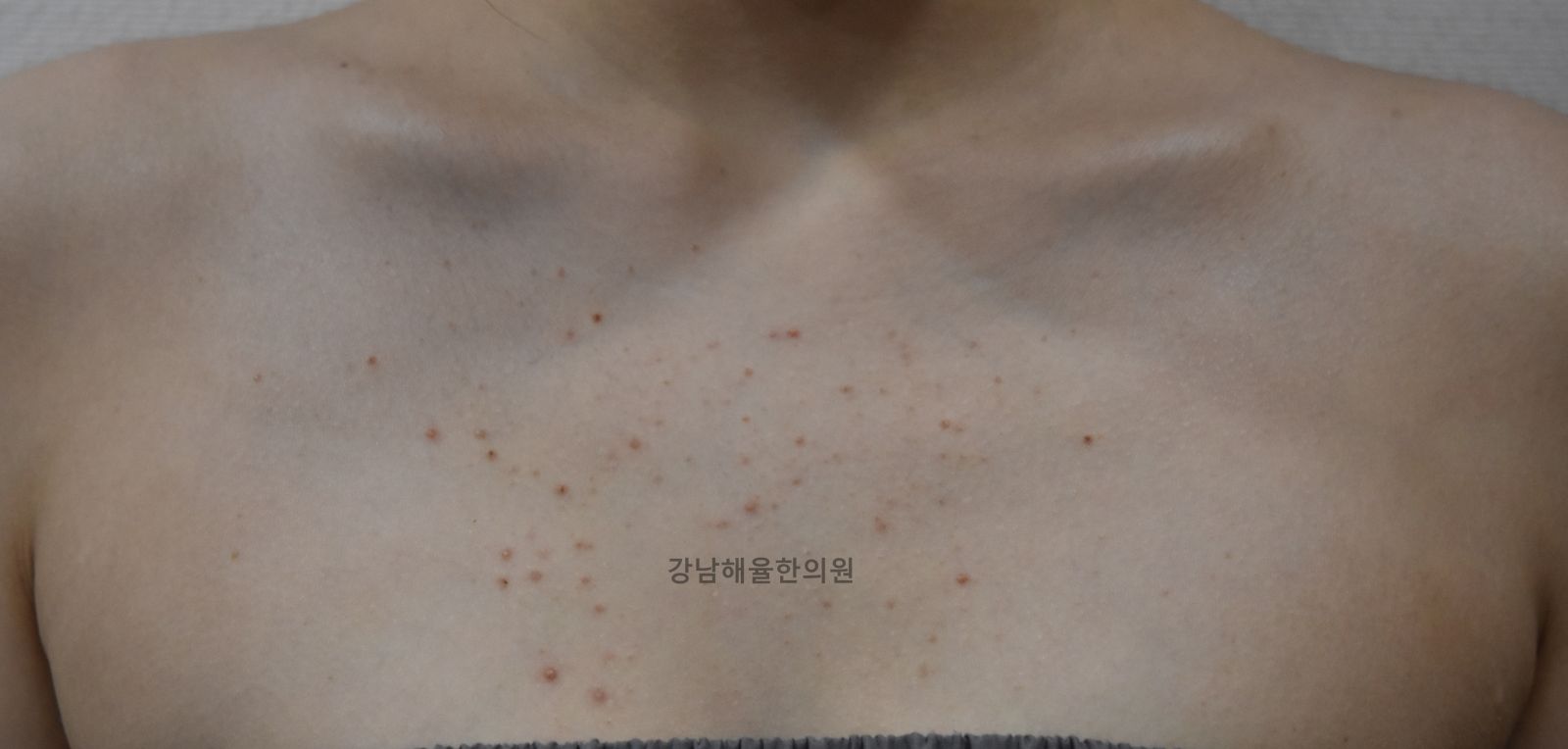 [강남점] 강남가슴여드름 생기는 순간부터 달라져야 할 관리법 - 해율한의원