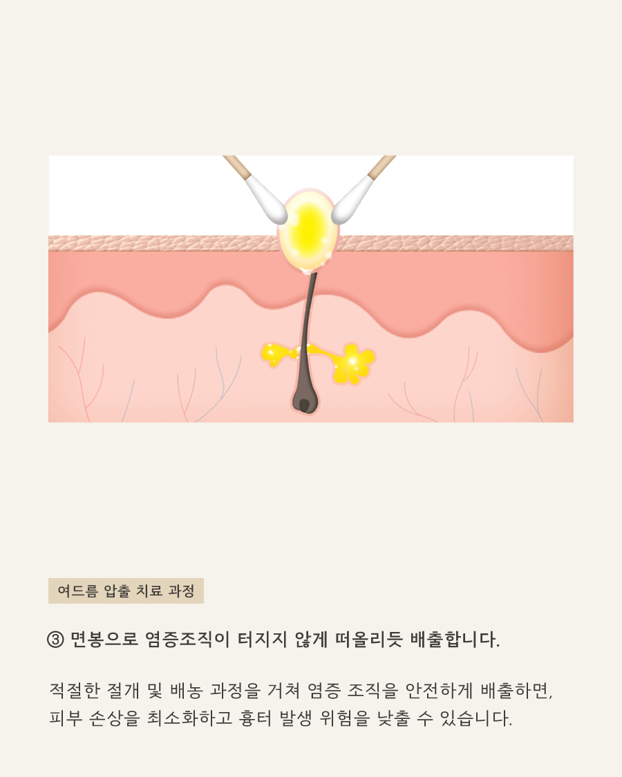 [홍대점] 홍대여드름한의원 운동 후 여드름이 심해지는 이유는 무엇인가요? - 해율한의원